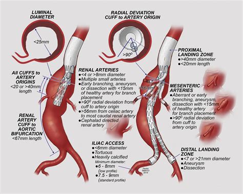 endovascular repair  thoracoabdominal aortic aneurysm