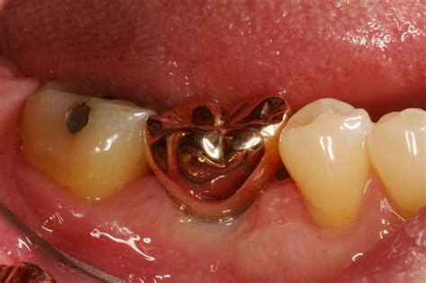 gold crowns advanced dentistry dental implant center