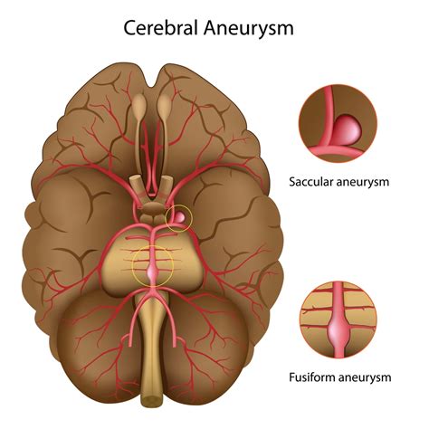 brain aneurysm net health book