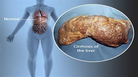 cirrhosis   liver stages symptoms treatments