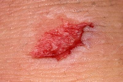 healing wound stock image  science photo library