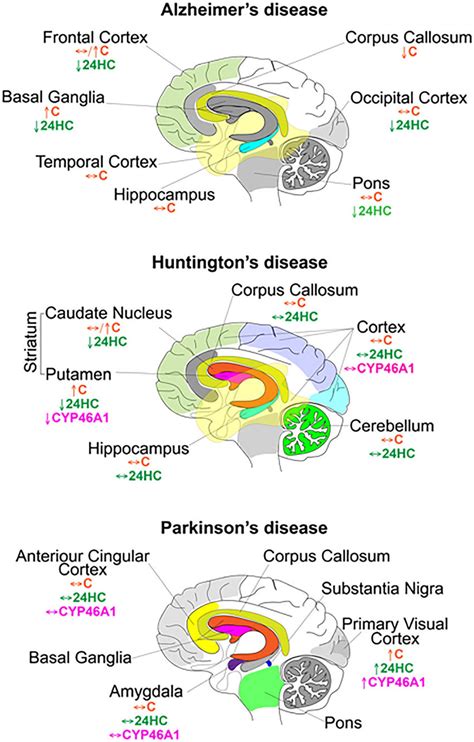 brain regions affected  alzheimers huntingtons  parkinsons