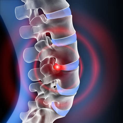 degenerative disc disease shore spine pain
