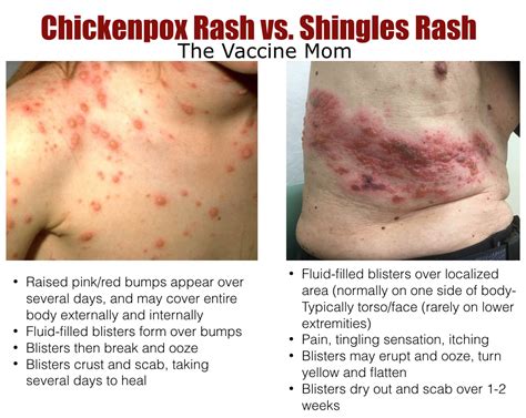 early sign and symptoms of chicken pox shingles