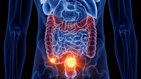 little known colon cancer symptoms to look out for
