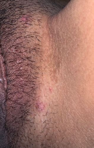please help are these genital warts mixed diagnosis sexual health