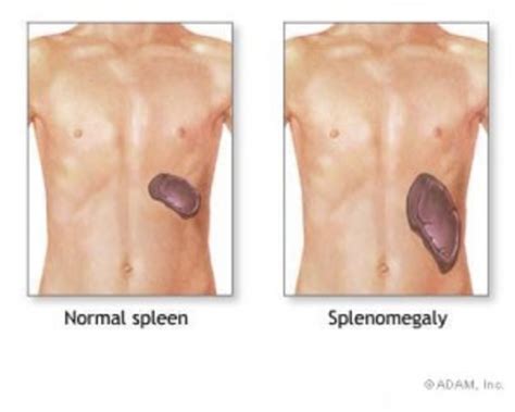 enlarged spleen symptoms  diagnosis treatment  dr