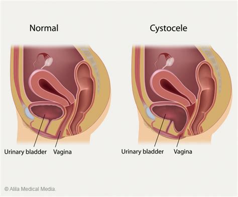 prolapsed bladder cystocele repair surgery plano frisco dallas tx