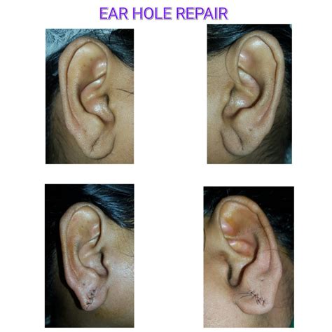 earlobe repair and piercing curves cosmetic surgery skin
