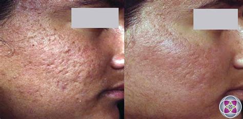 laser treatment for acne scars