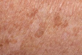 tri cities skin cancer age spots