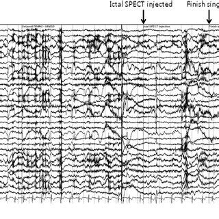 ictal singing due   mesial temporal lobe epilepsy