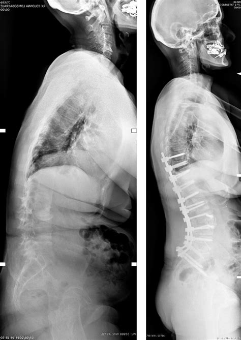Lumbar Lordosis Correction With Interbody Hyperlordotic Cages Initial