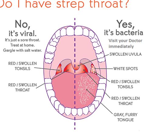 Sign In Strep Throat Throat Remedies Strep Throat Remedies Erofound