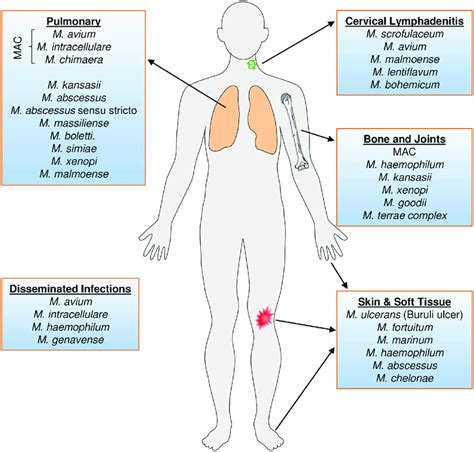 Body Sites Affected By Ntm Species Pulmonary Infections Are Generally