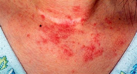 Eczema Symptoms And Diagnosis