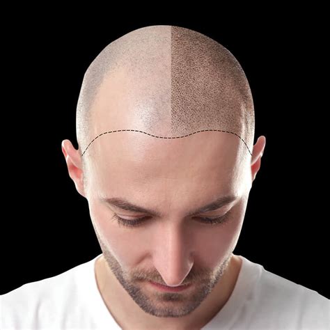 scalp society scalp micropigmentation