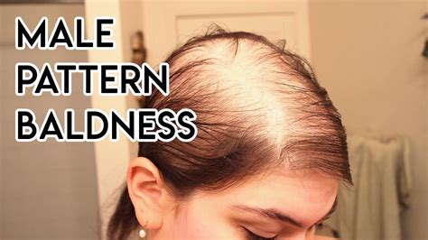 Treating Male Pattern Baldness Youtube