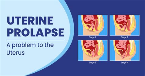 uterine prolapse symptoms causes risk and prevention