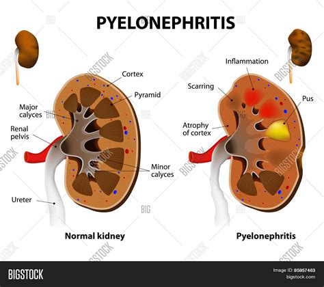 pyelonephritis vector photo  trial bigstock