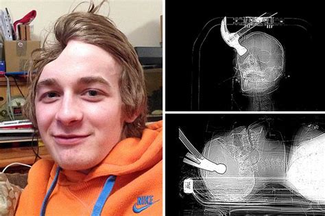 Gay Man S Head Smashed With Hammer By Flatmate [graphic Photos] The Trent