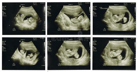 sei ricerche di ultrasuono del bambino gemella a 12 settimane