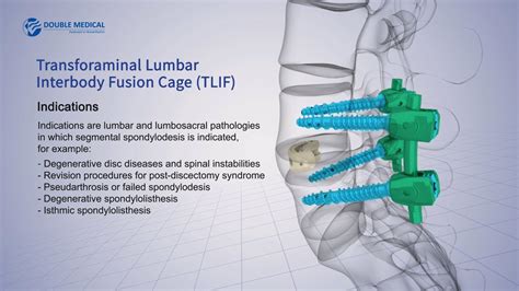 Double Medical Transforaminal Lumbar Interbody Fusion Cage Tlif Youtube