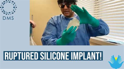 ruptured silicone implant en bloc specialist dr khan breast