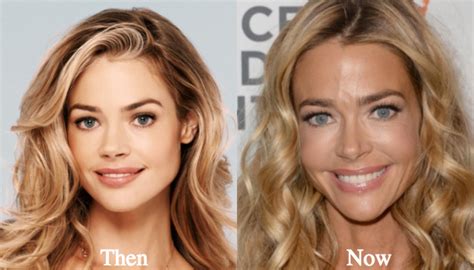 denise richards plastic surgery before and after photos latest