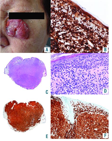 alk negative primary cutaneous anaplastic large cell lymphoma