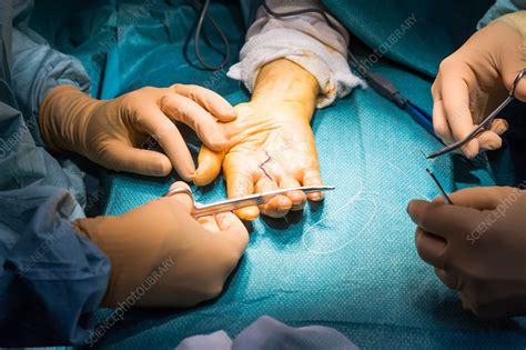 hand surgery stock image  science photo library