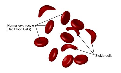 anemia   type  science