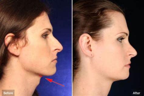 Facial Feminization Surgery Tracheal Shave Removing The Adam S