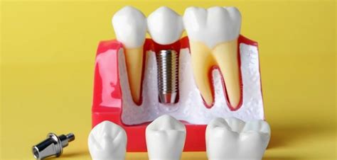 clean dental implants properly step  step house