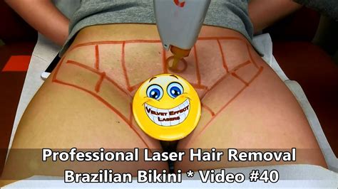 brazillian bikini laser hair removal nude photos
