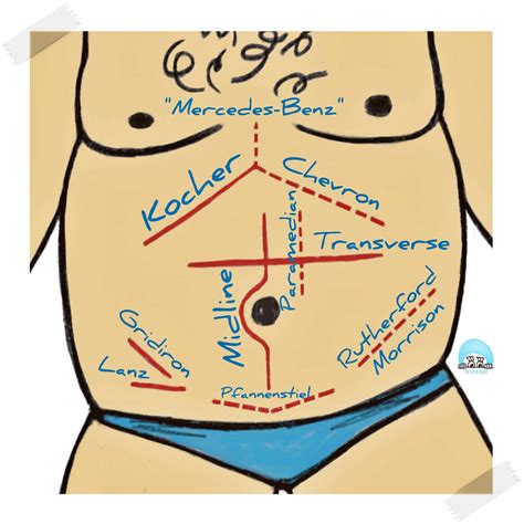 abdominal incisions  names  anatomical locations  scrub nurse