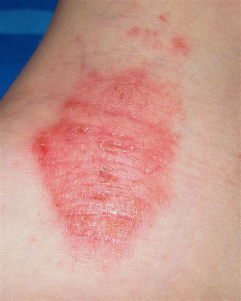 identifying  common red spots  skin universal dermatology