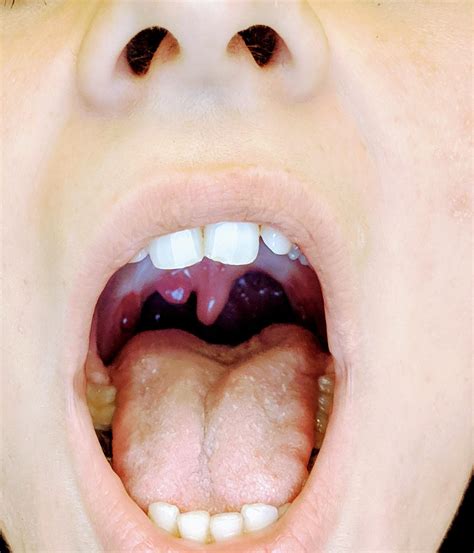 finally looked   apparently    bifid uvula       population