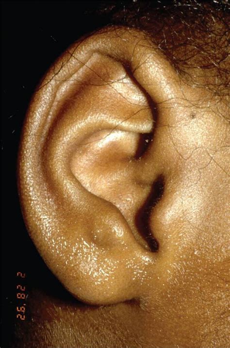 ear pits  tags visual diagnosis  treatment  pediatrics  ed