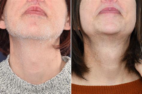 result after 38 hours of electrolysis before and after ffs 2pass clinic