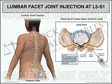 lumbar facet joint injection    trial exhibit female stock trial exhibits