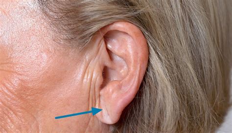 earlobe crease diagonal earlobe crease  heart disease