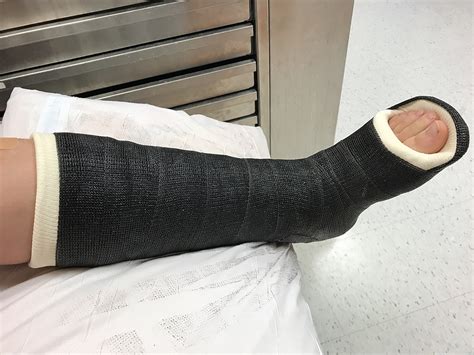 hospitals remove  cast   leg video