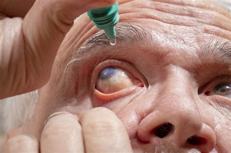 Electronic Monitoring Device May Improve Glaucoma Drop Compliance