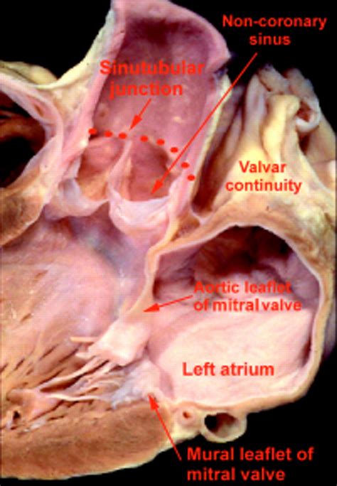 clinical anatomy   aortic root heart