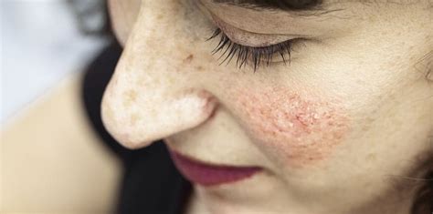 effective acne rosacea treatment  los angeles dr brian mekelburg