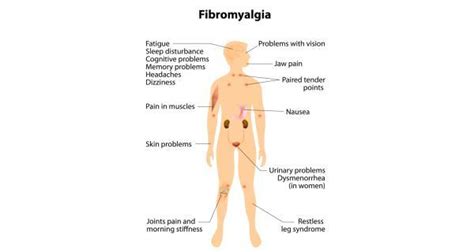 Fibromyalgia Treatment Fibromyalgia Symptoms And Causes