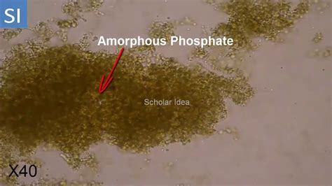 amorphous phosphate crystals  urine youtube