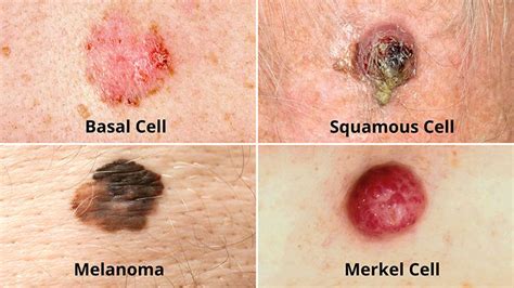 What Are The Different Types Of Skin Cancer Everyday Health