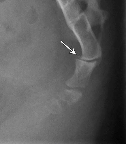 coccyx fracture xray